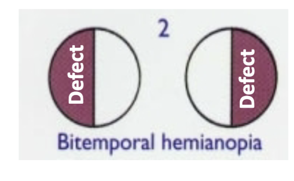<p>loss of vision laterally in both visual fields → called bitemporal hemianopia</p>