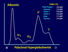 <p>=polyclonal gammopathy</p><p>seen w/ inflammation </p><p>(also liver disease, autoimmune disorders)</p>
