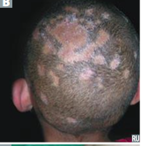 <p>presentation of tinea capitis</p>