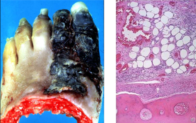<ul><li><p>audiniai pajuoduoja, susiraukšlėja</p></li><li><p>mikroskopiškai - nekrozės stuktūriniai pakitimai</p></li></ul><p></p>