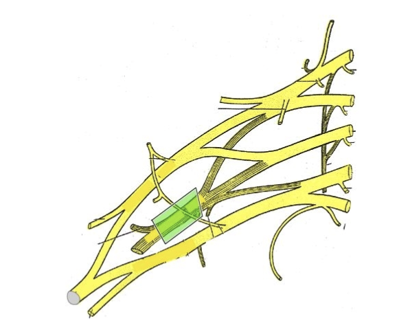 <p>Medial cord gives rise to the ulnar nerve </p><p>The medial & lateral cords give rise to the median nerve. </p><p>The posterior cord becomes the radial nerve. The radial nerve terminates as the dorsal digital nerve.</p>