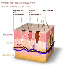 <p>Basal Cell Carcinoma</p>