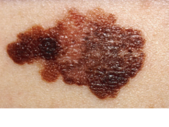 <p>a serious type of cancer that starts in the pigment-producing cells of the skin</p>