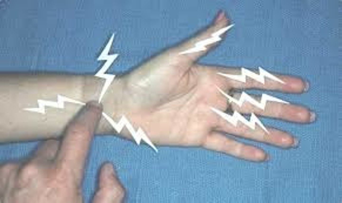<p>Ulnar nerve dysfunction (elbow) median nerve dysfunction (wrist) common fibular nerve (knee) posterior tibial nerve (ankle)</p>