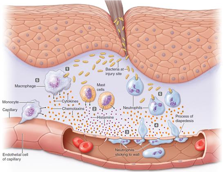 <ul><li><p>A break in the skin introduces bacteria, which reproduce at the wound site. Activated resident <strong>macrophages engulf the pathogens</strong> and <strong>secrete cytokines and chemotaxins</strong></p></li><li><p>Activated <strong>mast cells release histamine</strong> which dilates local blood vessels and widens the capillary pores</p></li><li><p><strong>vasodilation</strong> increases blood delivery to injury site and increased permeability of pores leads to fluid accumulation —→ <strong>redness, heat, swelling, pain</strong></p></li><li><p><strong>cytokines </strong>cause neutrophils and monocytes to stick to vessels and <strong>chemotaxins</strong> attract neutrophils and monocytes which squeeze between cells (diapedesis) and <strong>migrate to the site</strong></p></li><li><p>Monocytes enlarge into macrophages. Newly arriving <strong>macrophages and neutrophils engulf the pathogens and destroy them</strong></p></li></ul><p></p>