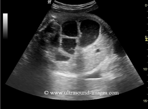 <ul><li><p>congenital narrowing or obstruction of small bowel</p></li><li><p><span style="color: red;">MC in proximal jejunum or distal ileum</span></p></li><li><p>general rule: the more distal the obstruction, the less severe the polyhydramnios</p></li><li><p>causes of fetal small-bowel obstruction</p></li></ul><p></p>