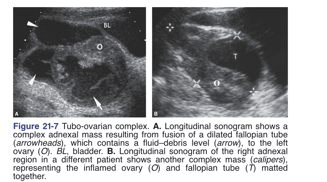 <p>Adhesion that develop within pelvis that leads to fusion of the ovaries and dilated tubes</p>