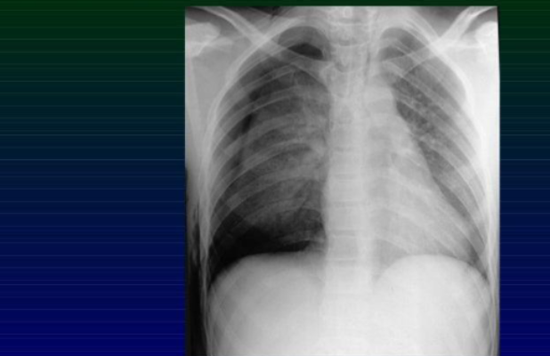 <p>ICG: is this a pulmonary contusion, pneomothorax, or hemothorax</p>