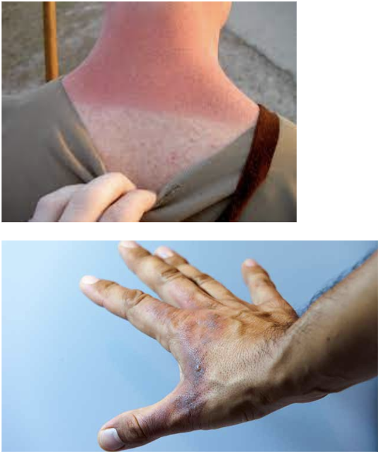 <p>aka 1st degree </p><ul><li><p>involves <strong>ONLY EIPDERMAL LAYER </strong></p></li><li><p>area pink to red; slightly edematous, usually <strong>NO BLISTERING </strong></p></li><li><p>on dark skin: appears reddish-brown </p></li><li><p>healing time: 3-5 days </p></li></ul><p></p>