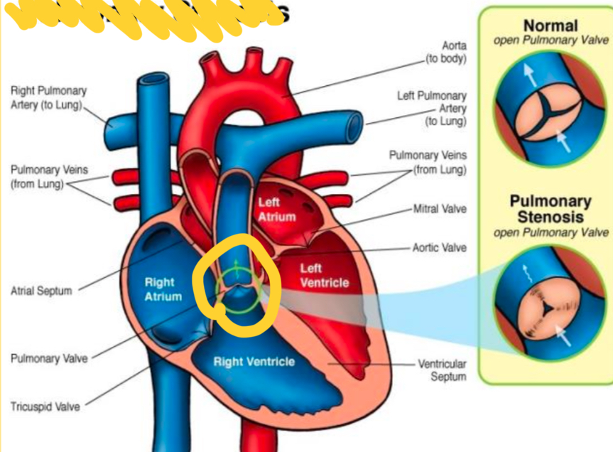 <p>narrowing of pulmonic valves that obstructs blood flow from the right ventricle toward the pulmonary arteries and lungs</p>