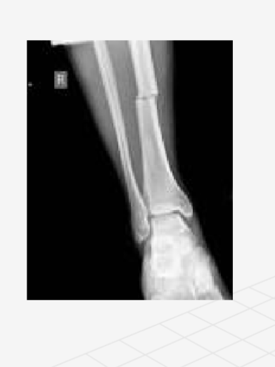 <p>what type of fracture?</p>