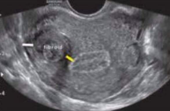 <p>What type of fibroid is depicted in this image? </p><p>A. Intramural </p><p>B. Submucosal </p><p>C. Subserosal </p><p>D. Pedunculated</p>