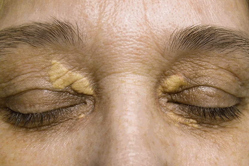 <p>soft raised yellow plaques occurring on skin at inner corners of eyes</p>