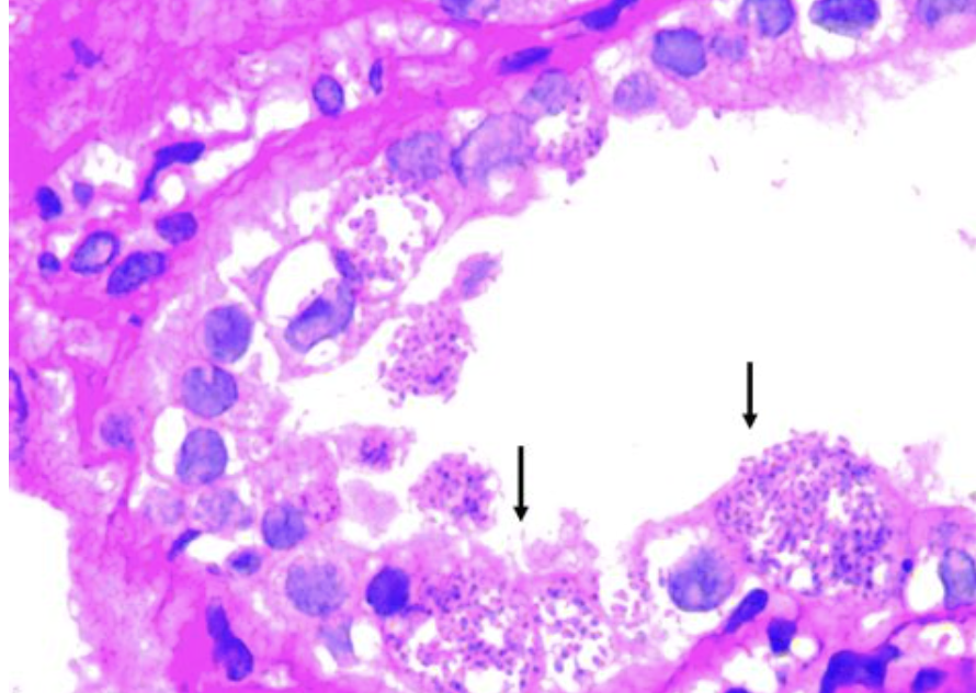 <p>Patient HIV</p><p>1) diagnostic </p><p>2) histologie </p>