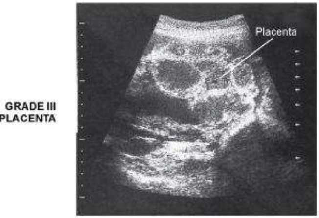<p>Obvious indentations in chorionic plate that extend as far as basal layer- divides placenta into segments; basal layer of placenta has very long, linear, highly echogenic echoes; may contains both bright highly echogenic areas and anechoic areas; considered normal at any time after 38 weeks of development</p>