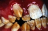 <p><span>Radiographic features: Enamel reduced in bulk, shows thin layer over occlusal.</span></p>