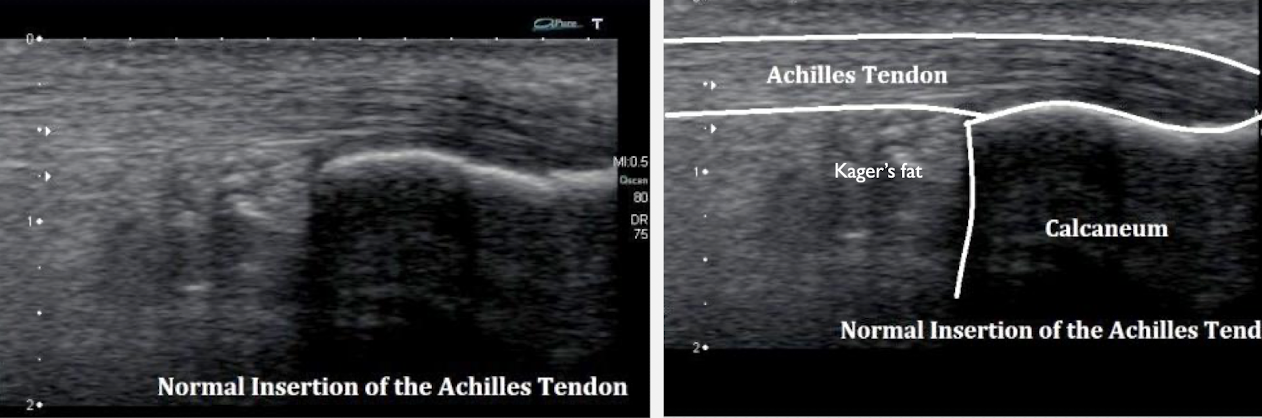 <ul><li><p>MC injured ankle tendon</p></li><li><p>connects the calf muscle to the calcaneus (posterior surface of the feel)</p></li></ul><p></p>