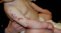 <p>hemangioma complications</p>