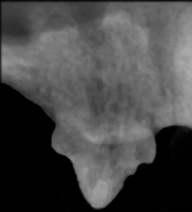 <p>Which tooth resorption stage?</p>
