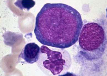 <p>Also known as pronormoblast or proerythroblast</p><p>Earliest and largest cell in the erythroid series</p><p>Cell size is 14-24 micrometers</p><p>Nucleus</p><ul><li><p>Nucleus is round (almost spherical) with distinct, linear chromatin strands</p></li><li><p>Nuclear to cytoplasmic ratio is high (8:1 to 6:1)</p></li><li><p>Nucleus stains reddish-blue with 0-5 nucleoli visible</p></li><li><p>Chromatin: blue, fine, diffuse, loose, no evidence of clumping</p></li></ul><p>Cytoplasm is deep royal blue; scant amount with no granules</p><p>Reference range: 0-1.5% in bone marrow</p><p></p>