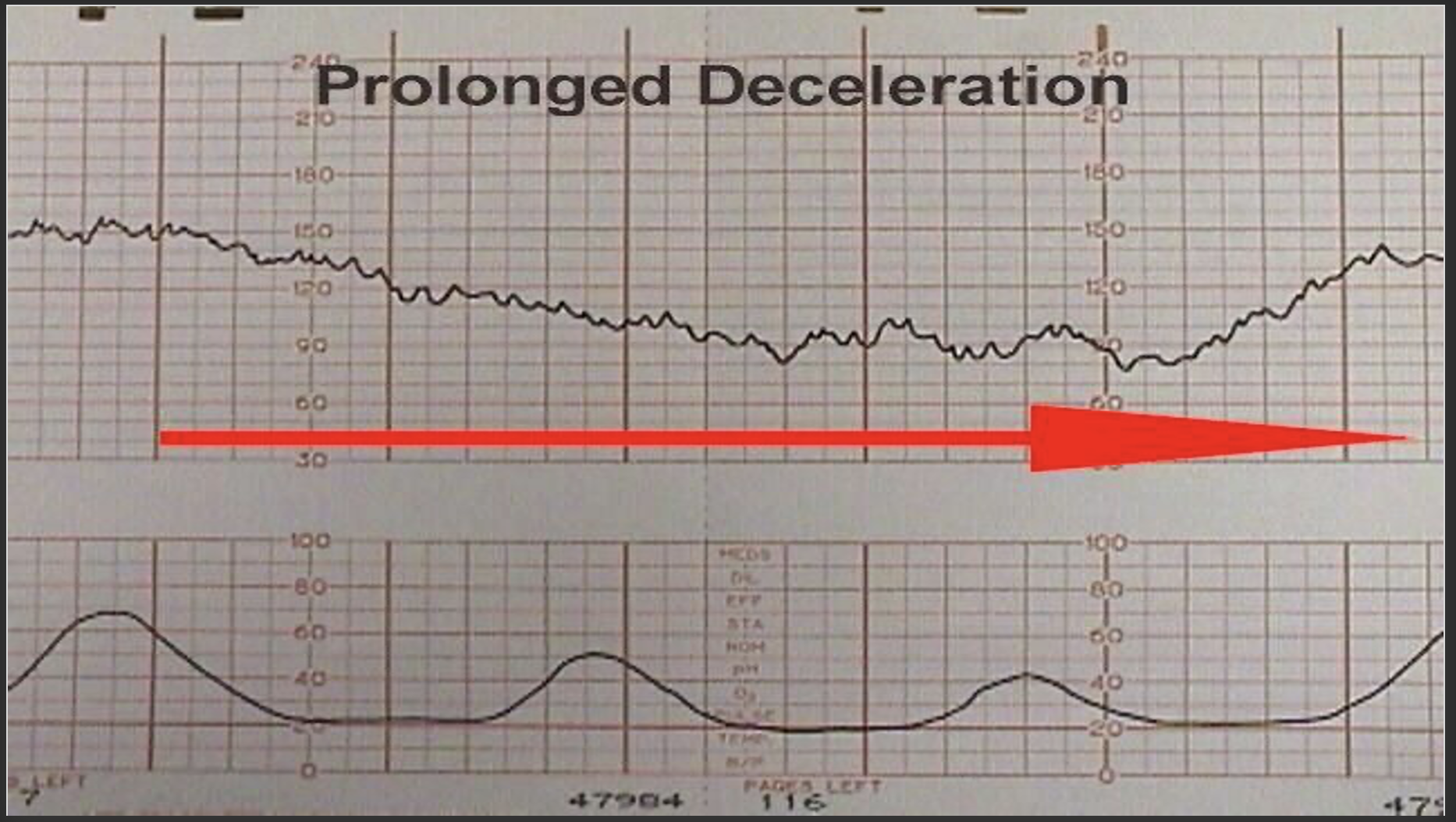 <p>Prolonged deceleration </p>