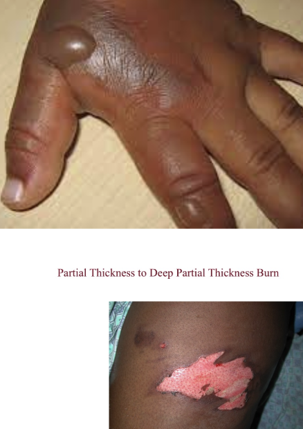 <p>2nd degree burns</p><ul><li><p>involves <strong>ENTIRE epidermal layer AND varying depths of DERMAL LAYER</strong></p></li><li><p><strong>BLISTERS!!</strong></p></li><li><p>further broken down into superficial partial thickness burns and deep partial thickness burns</p></li></ul><p></p>