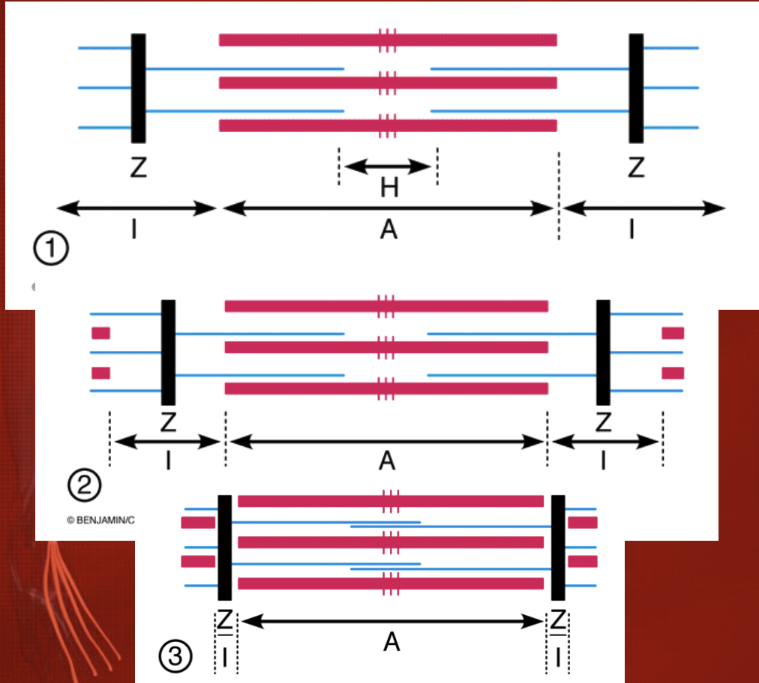 <ul><li><p><span>Mỗi sarcomere có khoảng 2000 xơ actin (mỏng) và khoảng 1000 xơ myosin (dày)</span></p></li></ul><p>+ Giữa chiều dài các xơ actin có <span style="background-color: rgb(153, 204, 255);">đĩa Z</span> --> xơ actin nằm ở 2 sarcomere kề nhau</p><p><span>+ Kề vạch Z chỉ có xơ actin --> </span><span style="background-color: rgb(153, 204, 255);">dải I</span></p><p>+ Vùng có các xơ actin và xơ myosin lồng vào nhau --> <span style="background-color: rgb(153, 204, 255);">dải A</span></p><p>+ Phần chỉ có các xơ myosin --><span>&nbsp; </span><span style="background-color: rgb(153, 204, 255);">đĩa H</span></p><p>+ Phần giữa các xơ myosin dày lên --> <span style="background-color: rgb(153, 204, 255);">đường M</span> = nằm ở trung tâm sarcomere</p><p>&nbsp;</p><ul><li><p><span>Khi cơ co 2 vạch Z gần nhau: xơ myosin và xơ actin chồng lên nhau nhiều hơn (chiều dài các xơ không đổi); dải I và vùng H ngắn lại.</span></p></li><li><p><span>Khi các xơ myosin chạm vào vạch Z thì cơ ở mức co tối đa</span></p></li></ul><p></p>