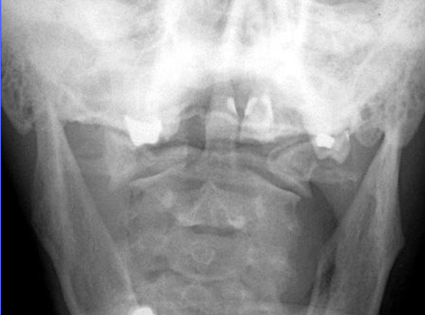 <p>What is the potential diagnosis for this male with an occipital headache after head butting someone playing football?</p>