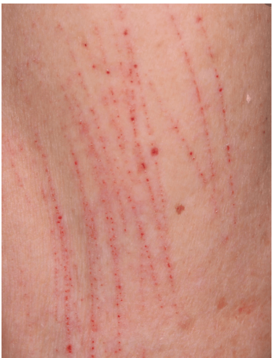 <p>Excoriation </p>