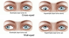 <p>a. Strabismus</p>
