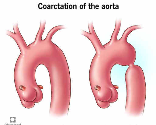 <p>Het betekend insnoering van de aorta, het is eigenlijk een zandlopervormige vernauwing hoog in de aorta descendens, na de aftakking van de linker arteria subclavia. Het is een niet-cyanotische aandoening met normale longcirculatie. </p><p>Door de vernauwing is er hypertensie in de bovenste lichaamshelft. Verschil tussen de RR van de R-arm en het R-been is, samen met het ontbreken van liespulsaties, een belangrijke indicatie. Voorbij de vernauwing is de RR lager, de bloedvoorziening van de onderste lichaamshelft komt hierdoor in gevaar. Symptomen zijn:</p><p>-Bij zuigelingen → koude benen en soms koude armen, oligurie, kortademig, sloomheid, slecht drinken, maag-darmproblemen.</p><p>-Symptomen op lange termijn door hoge RR → zichtsproblemen, hartkloppingen, overprikkelbaarheid en duizeligheid. </p><p>=> Door de slechte circulatie van het onderlichaams lijkt het klinisch beeld op shock. Deze verslechtering treed meestal op ronde de vierde dag na de geboorte en hangt samen met de sluiting van de ductus.</p><p>Prostaglandine wordt dan ook gebruikt om de ductus open te houden. Snelle chirurgische interventie met een coarctectomie of ballondilatatie (eventueel met stent) zijn daarna noodzakelijk.</p>