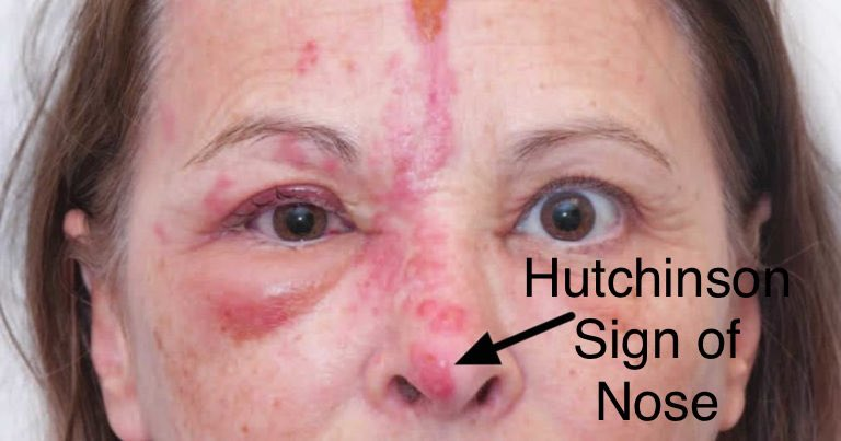 <p><span><span>The presence of a vesicular rash on the tip, side, or root of the nose indicating involvement of the nasociliary branch of the ophthalmic nerve (also supplies the cornea) → risk of corneal ulcers and loss of protective corneal sensation</span></span></p><p><span><span>usually seen in shingles/ Herpes Zoster Ophthalmicus (HZO)</span></span></p><p></p>