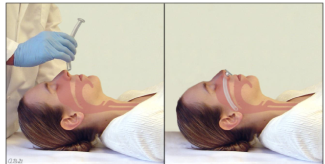 <p>Is inserted through the nose into the pharynx</p><p>Used on patients that are semi-conscious and have an intact gag reflex</p><p></p>