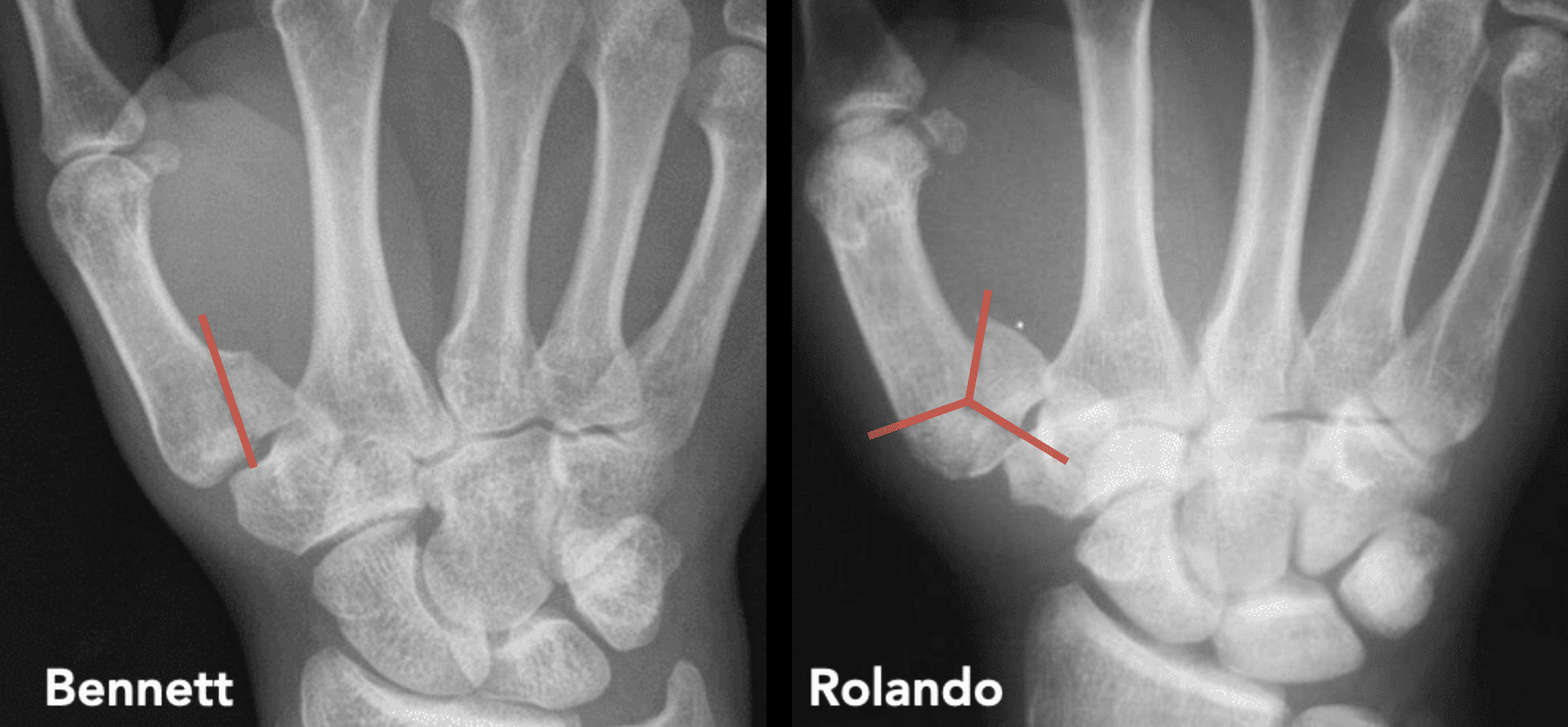 <p>Bennett Fracture: fracture/dislocation of the CMC</p><p>Rolando Fracture: >1 fractures involving articular surface</p>