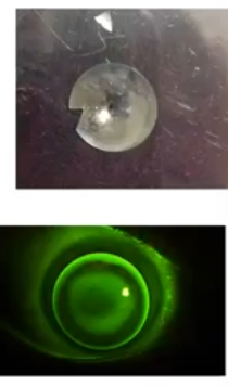 <p>rigid contact lenses </p>