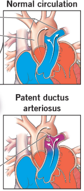 <p>a temporary blood vessel in a developing fetus that connects the main pulmonary artery to the aorta, allowing blood to bypass the unfunctioning <strong>lungs</strong></p>