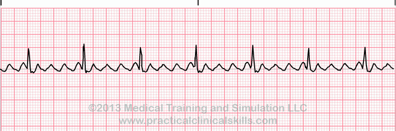 <p>the image shown depicts what cardiac arrhythmia?</p>