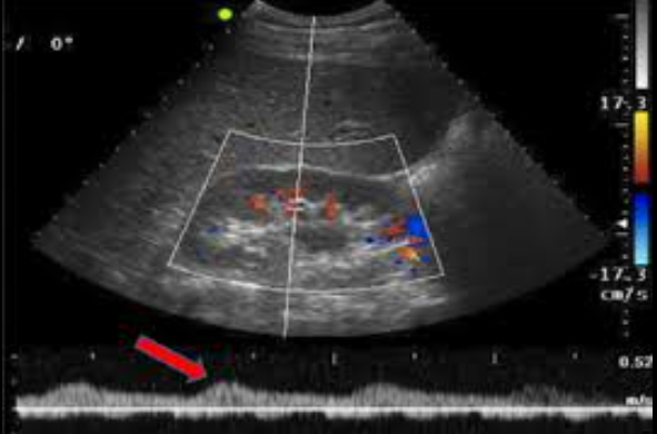 <p>- thickening and calcification of renal artery</p><p>- renal to aorta ratio above 3.5</p><p>- tardus parvus waveform</p>