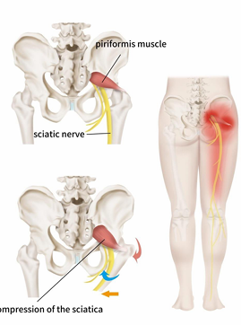<p><span style="color: red;"><strong>Piriformis Syndrome</strong></span><strong> (sciatic nerve) </strong>- <em>rritation of sciatic nerve between piriformis/ischial tuberosity </em></p>