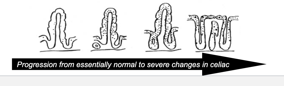 <p>hyperplasia </p><p>atrophy</p><p>villi will disappear and crypts will get huge</p>