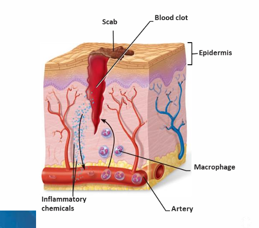 <p><strong>A scab</strong></p><ul><li><p>The clot <strong>dries</strong> and forms a protective scab</p></li></ul><p></p>