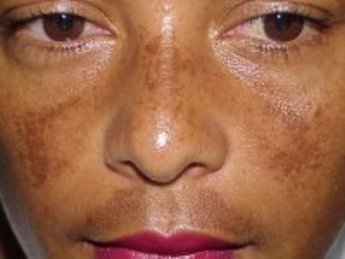 <p>a pigmentation disorder characterized by brownish spots on the face</p>