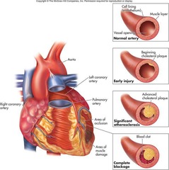 <p>Atherosclerosis, which is the buildup of plaque in the coronary arteries.</p>