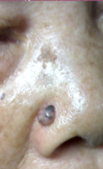 <p>variable amounts of melanin within the lesion, globules of pigment</p>