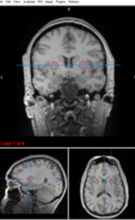 <p>putamen/globus pallidus</p>