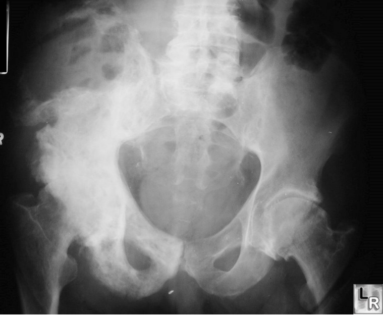 <p>Malignant (osteosacroma) </p>