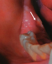 <p>most arise from lingual surface of the mandible adjacent to molars along mylohyoid ridge; linear ulceration, pain varies; TX = surgical removal </p>