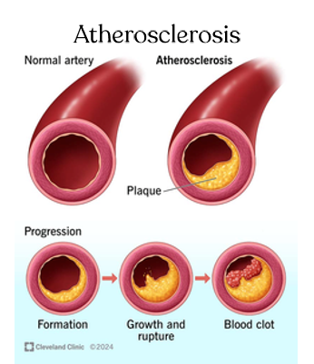 <p>cause: fatty plaque buildup in arteries</p><p>effects on circulation: narrowed arteries = reduced blood flow = increased blood pressure</p><p>treatment: balanced diet, exercise</p>