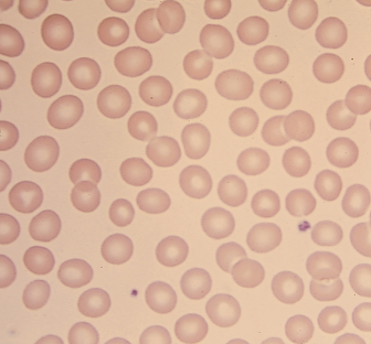 <p>What type of RBC distribution is this?</p>
