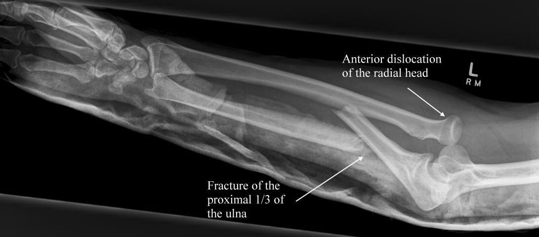 <p># proximal ulna + dislocation of the radial head</p>